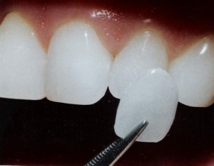 Close up photo of a porcelain veneer available in San Antonio at the office of Jurich Dental