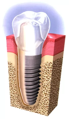 Dental implants, also known as tooth implants, are available to patients throughout San Antonio and Shavano Park.