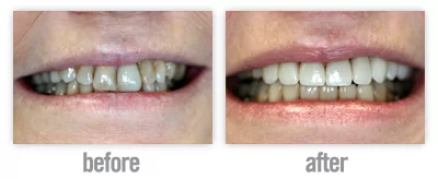 tooth whitening services in San Antonio