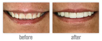 dental veneers for a perfect smile in San Antonio