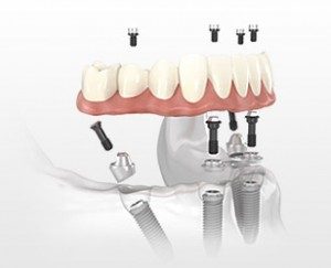 Those with missing or damaged teeth should try the All on 4 denture available in San Antonio and Shavano Park.