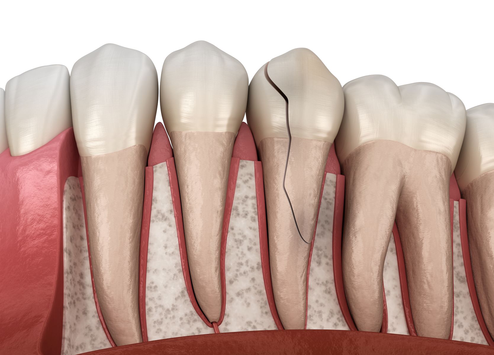 Cracked Tooth Repair - Restorative Dentistry - Jurich Dental San Antonio