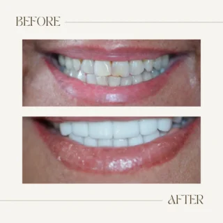 Before and after teeth veneers
