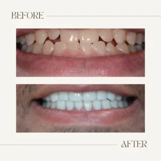 Before and after dental crowns
