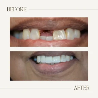 Before and after tooth replacement