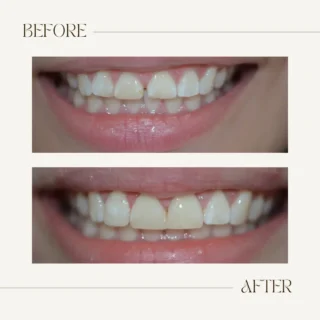 Before and after cosmetic bonding