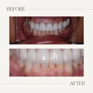 Before and after cosmetic dental treatment